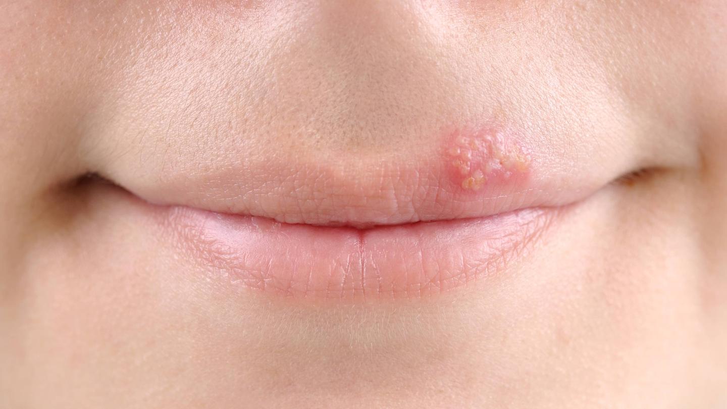 配图 你的嘴唇为什么会起泡 知乎