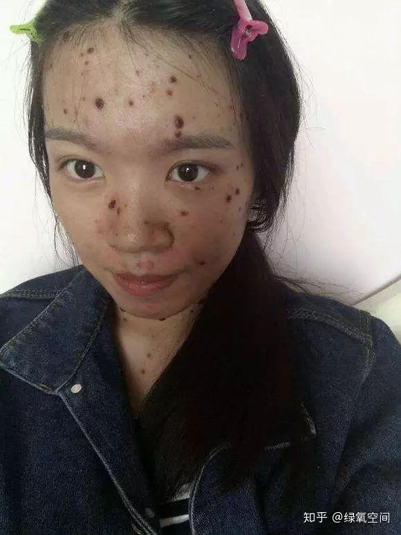 熬夜加班长痘痘怎么办
