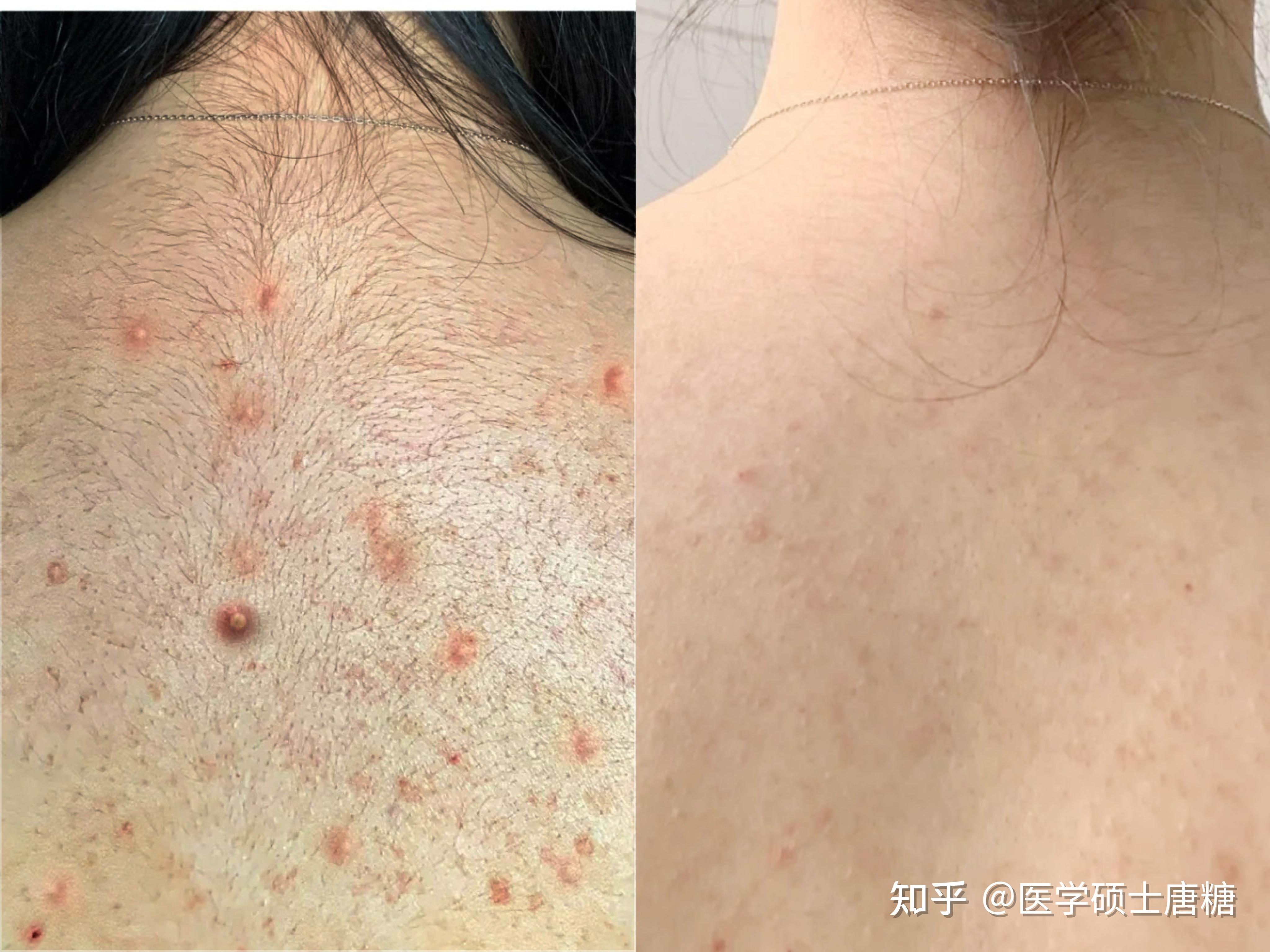 【后背祛痘指南】后背长了很多痘痘怎么办?又痒又难看?医学人教你正确的祛痘流程,简单4步,在家也能有效去除后背痘,彻底告别麻麻赖赖的大花背!