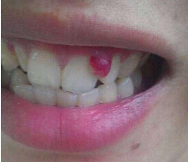 牙龈菜花状图片