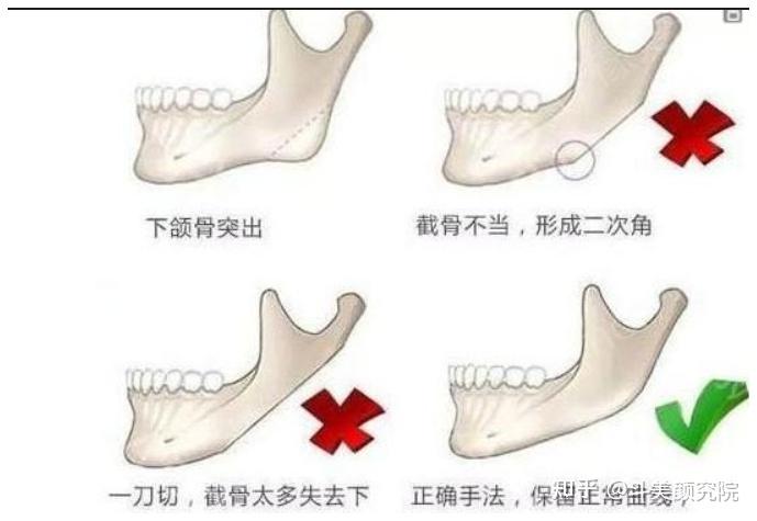 磨骨需要多少钱?有什么后遗症,国内哪里做骨骼项目好?