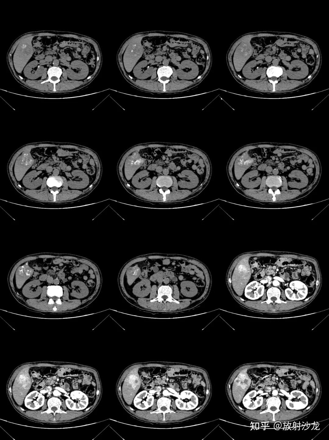 这样的肝内钙化灶你能想到这个病吗