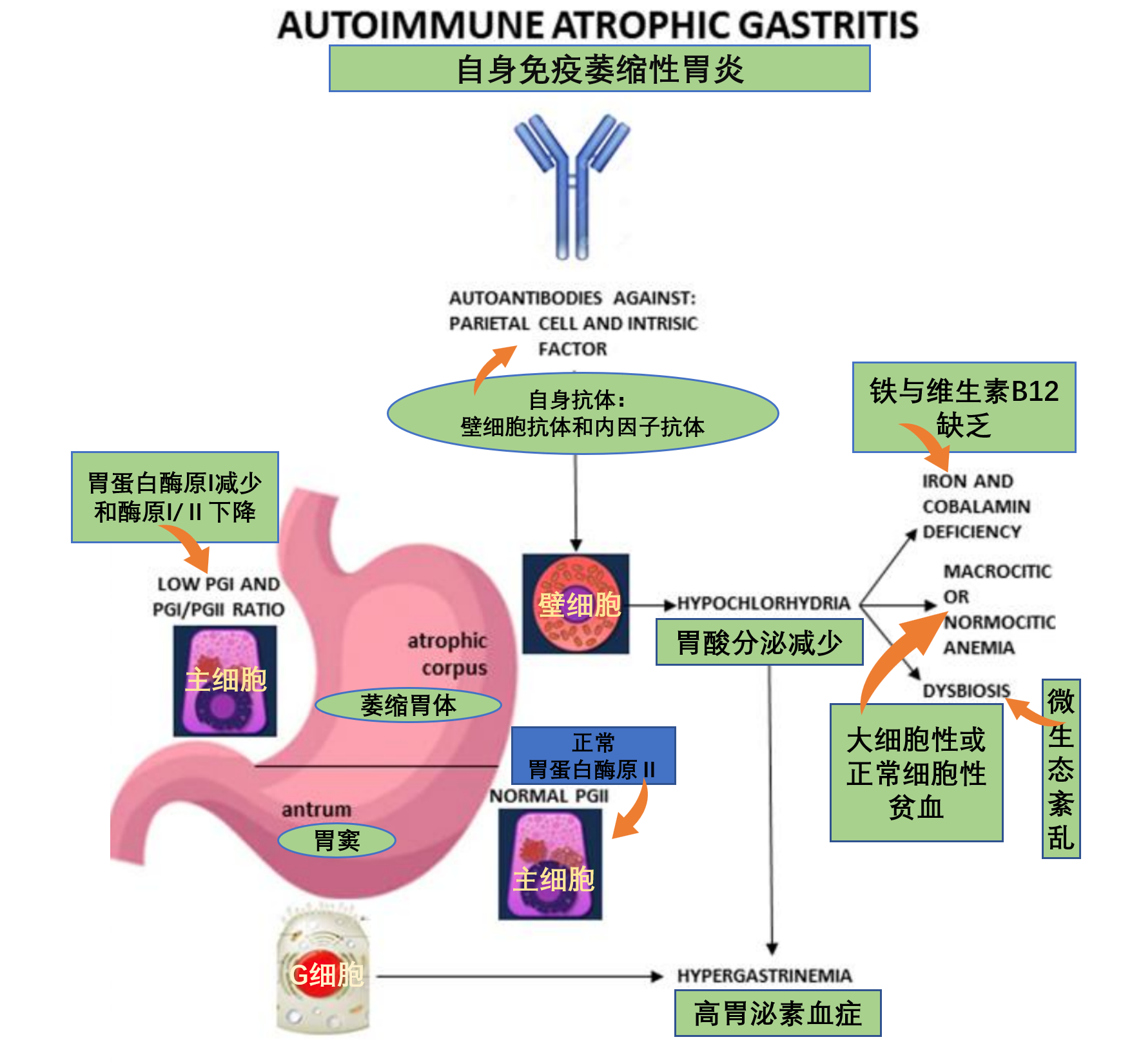 自身免疫性胃炎发病机制和临床诊断 - 知乎