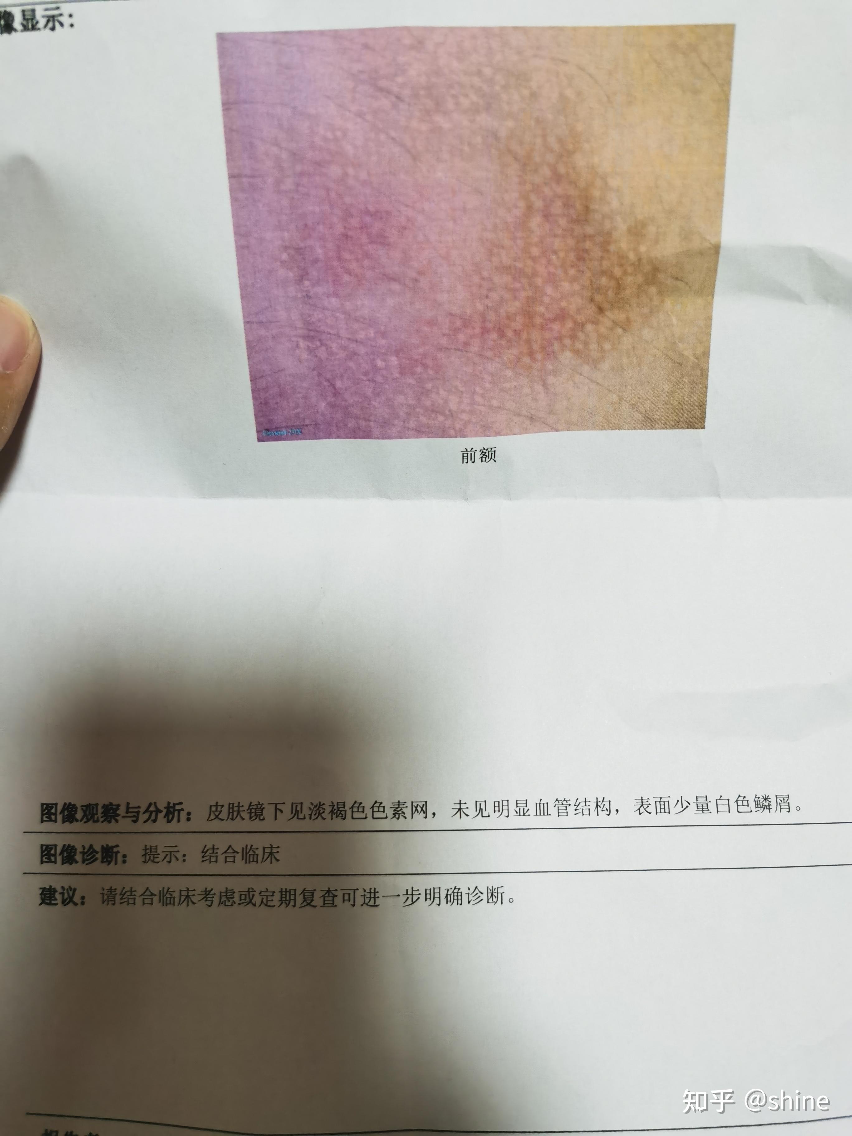 时深时浅,有说色素沉淀有说咖啡斑,有了解的大侠吗?