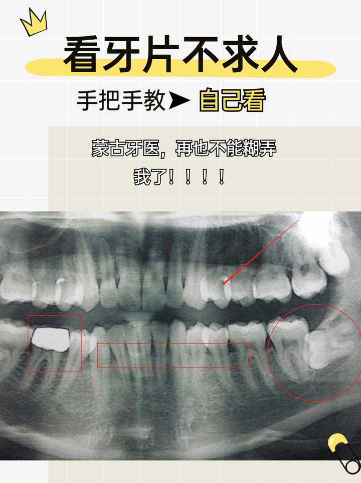 手把手教你自己看牙片