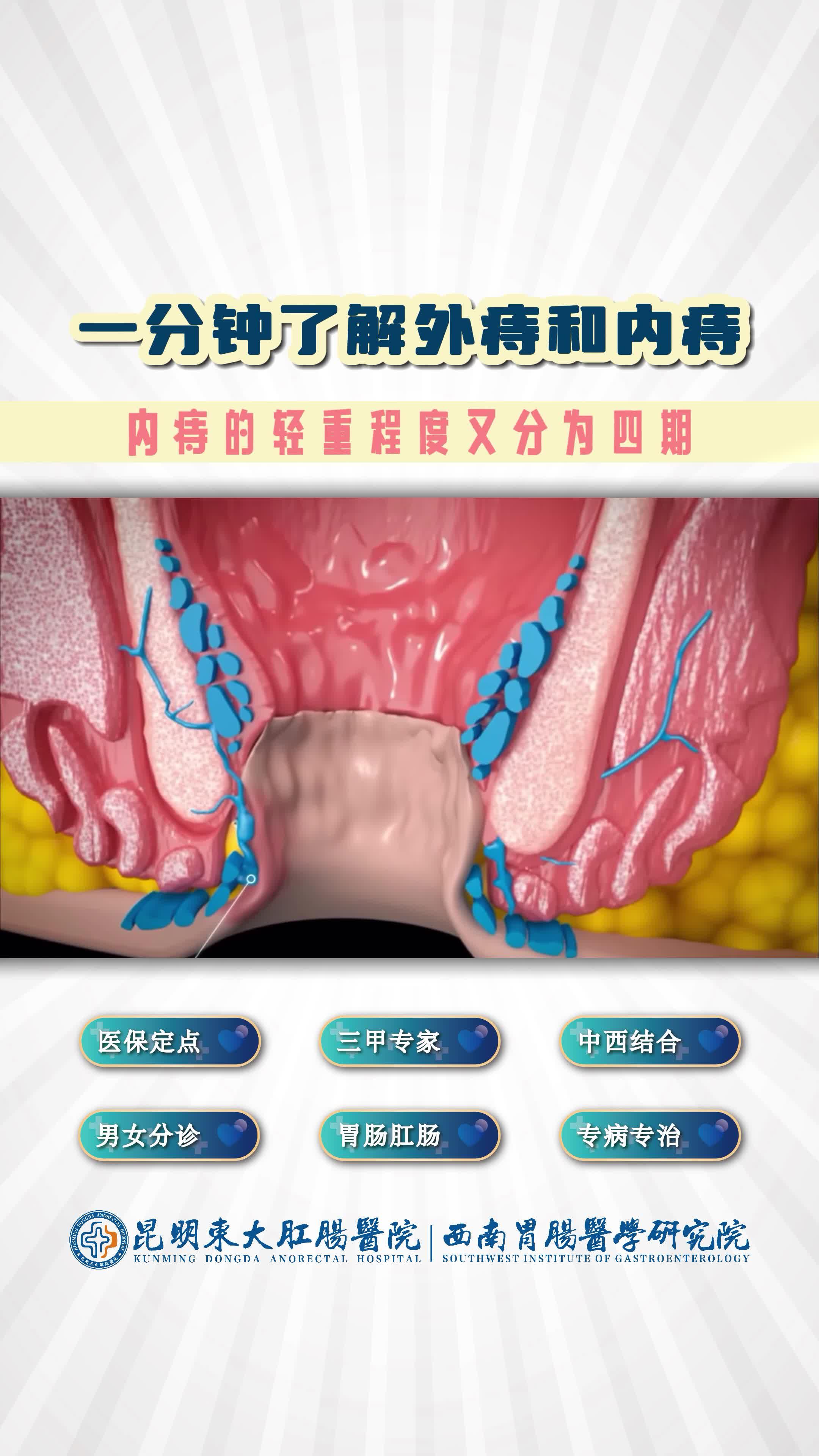 一分钟了解外痔和内痔