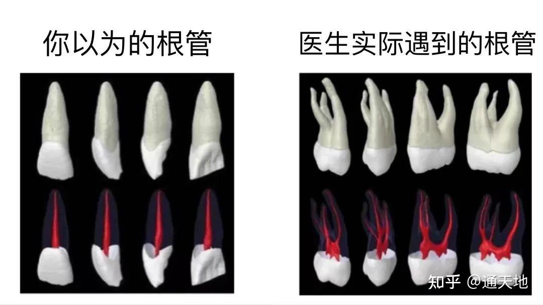 当根管治疗失败后,在拔牙之前,或许显微根尖手术还能给你带来新的希望 - 知乎