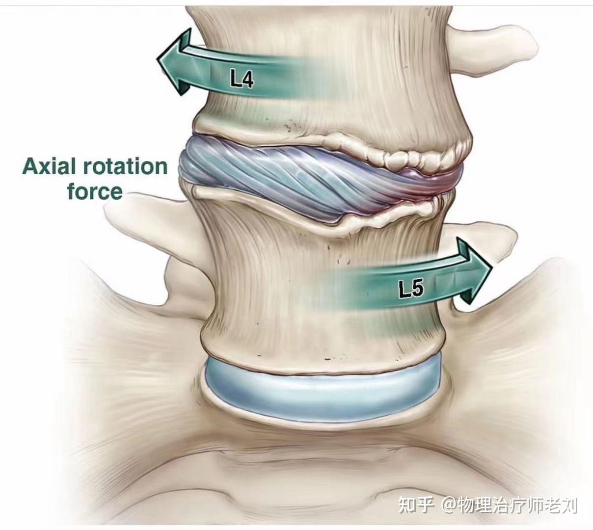 腰椎纤维环撕裂是怎么造成的
