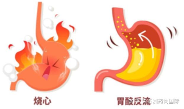 出现烧心、反酸要注意了！考虑是不是胃食管反流 - 知乎