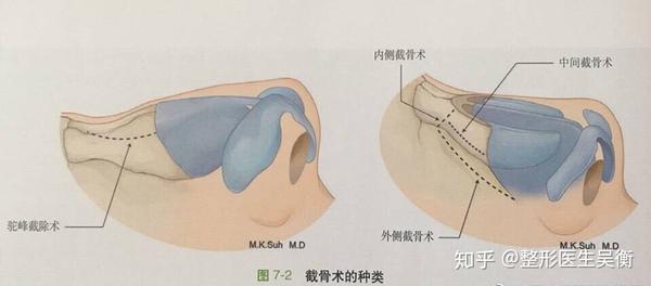 侧颜杀 侧脸好看的鼻子正脸可不一定好看 知乎