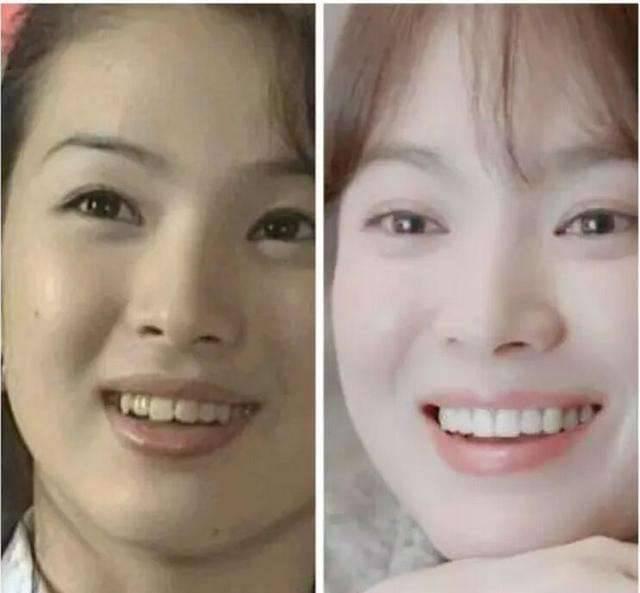 盘点娱乐圈整过牙齿的明星