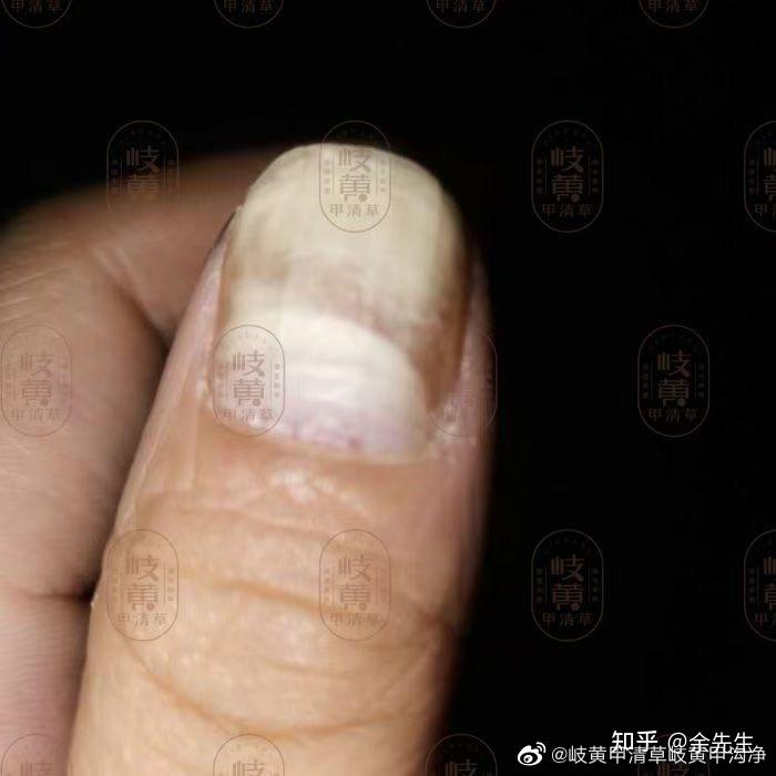 手大拇指指甲中有一块白了是什么原因? - 知乎