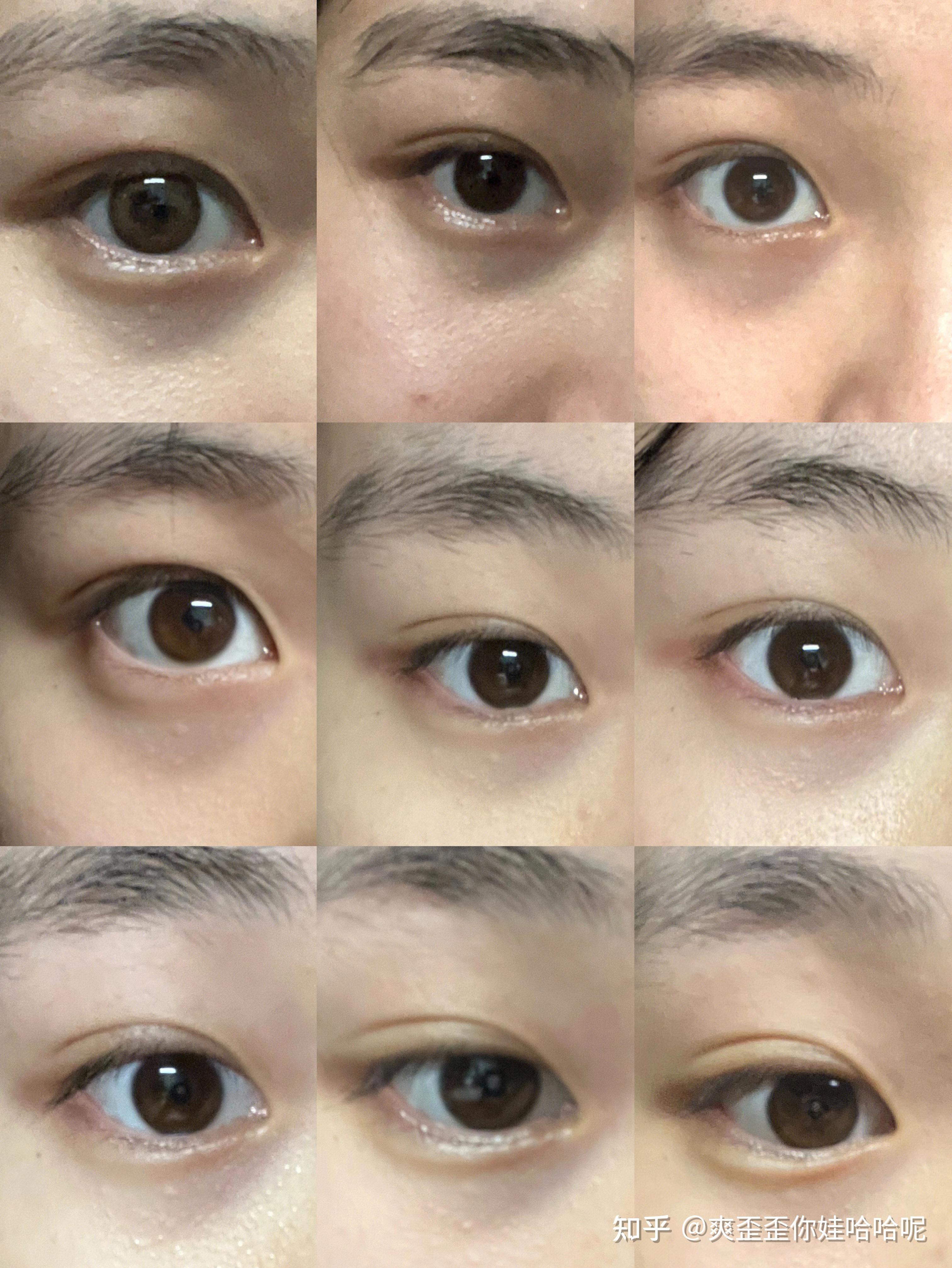 几年的黑眼圈怎么去掉? - 知乎