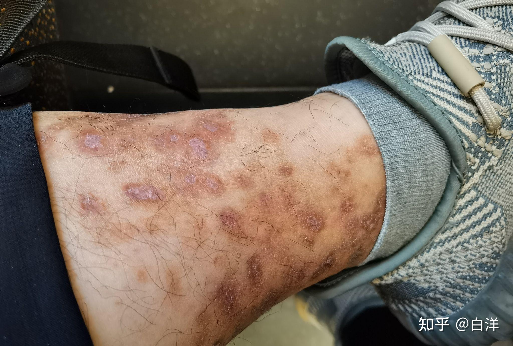 青斑性血管炎被困扰了5年之久欢迎来讨论下痊愈经历大家有痊愈的吗