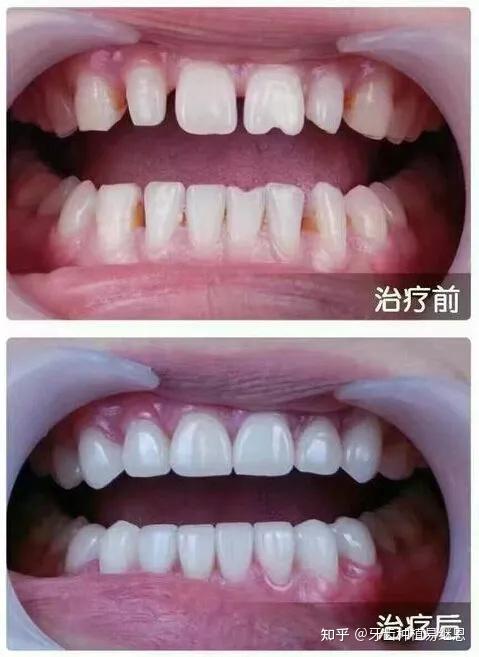 02.什么情况下可以做超薄瓷贴面