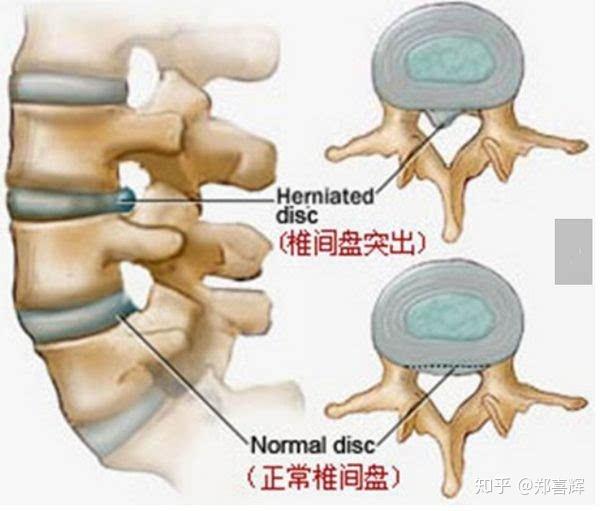 腰椎間盤突出壓迫神經痛吃什麼藥腰椎間盤突出壓迫神經痛吃什麼藥好