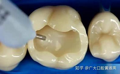 牙齿龋坏到什么程度,需要做根管治疗? - 知乎