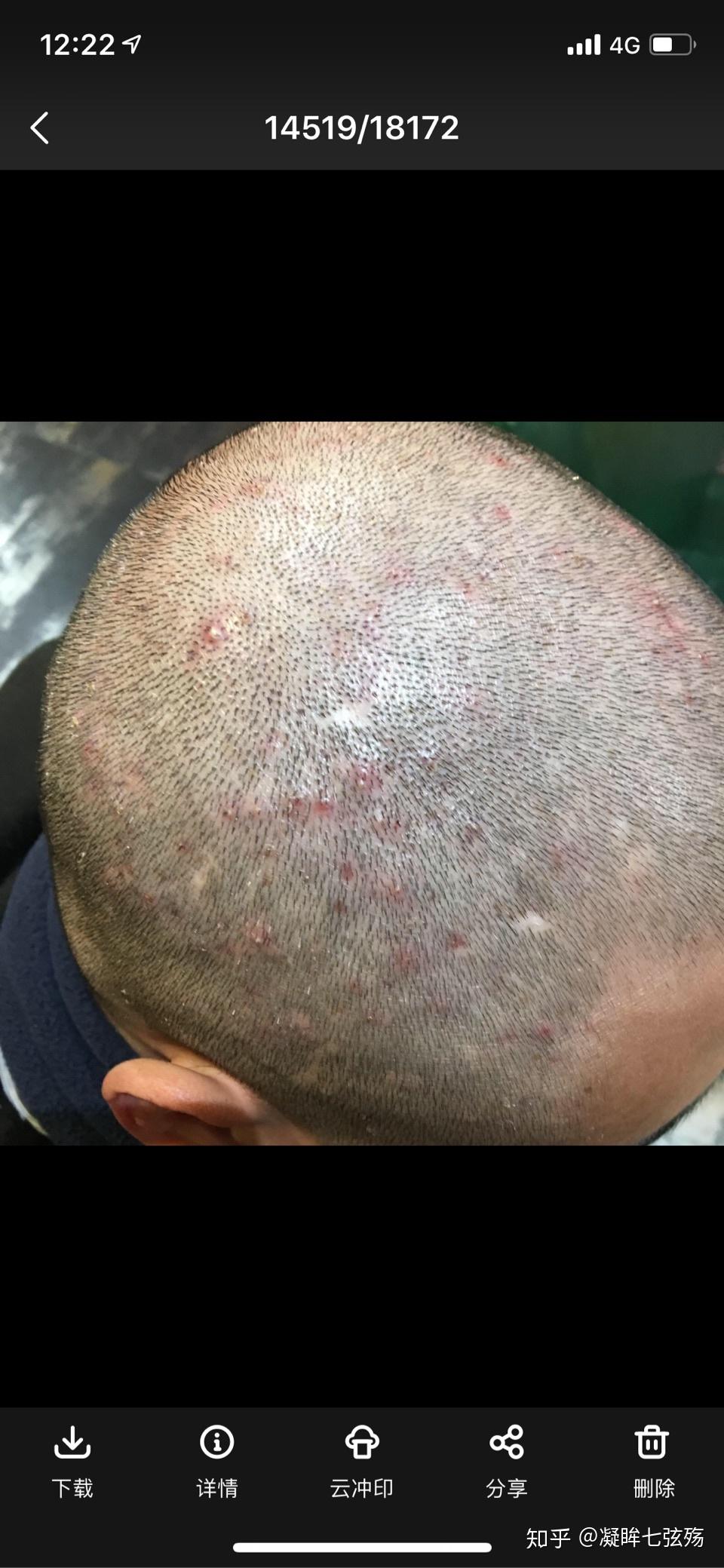 头部毛囊炎 三年了反复多次? - 知乎