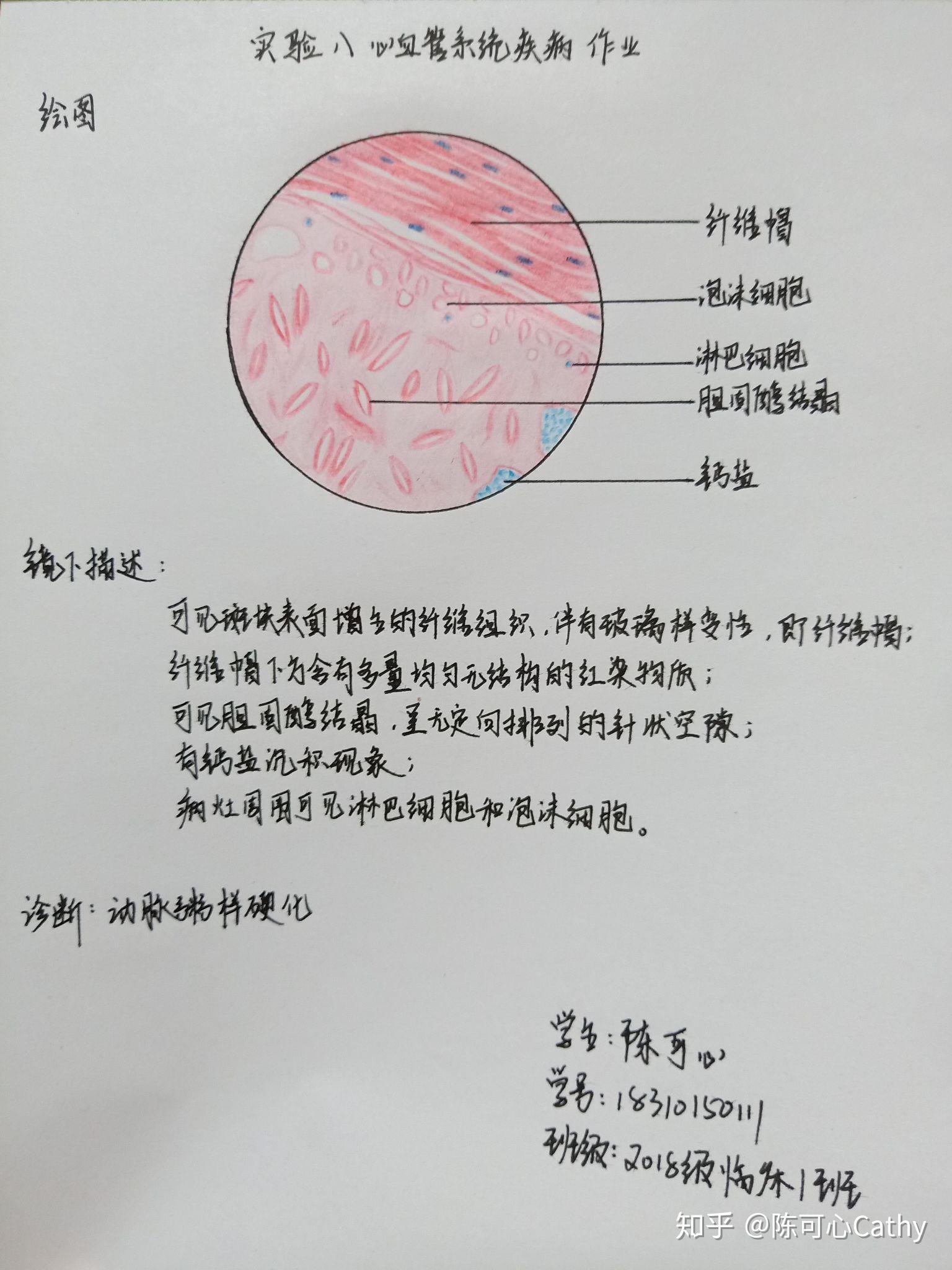 慢性阑尾炎红蓝铅笔图图片