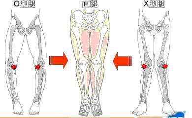 是膝关节髌骨向内对而腘窝向外,多数有股骨相对胫骨过度内旋,产生x型