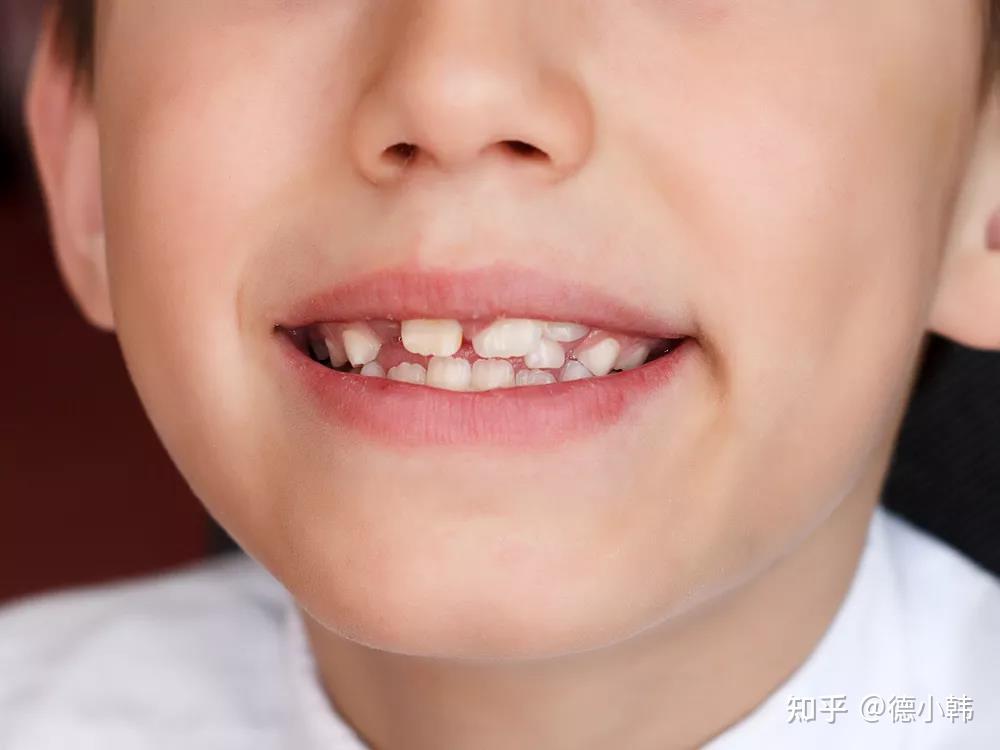 但是对应的乳牙不肯让位,恒牙错位萌出甚至出现双排并列情况,牙齿越长