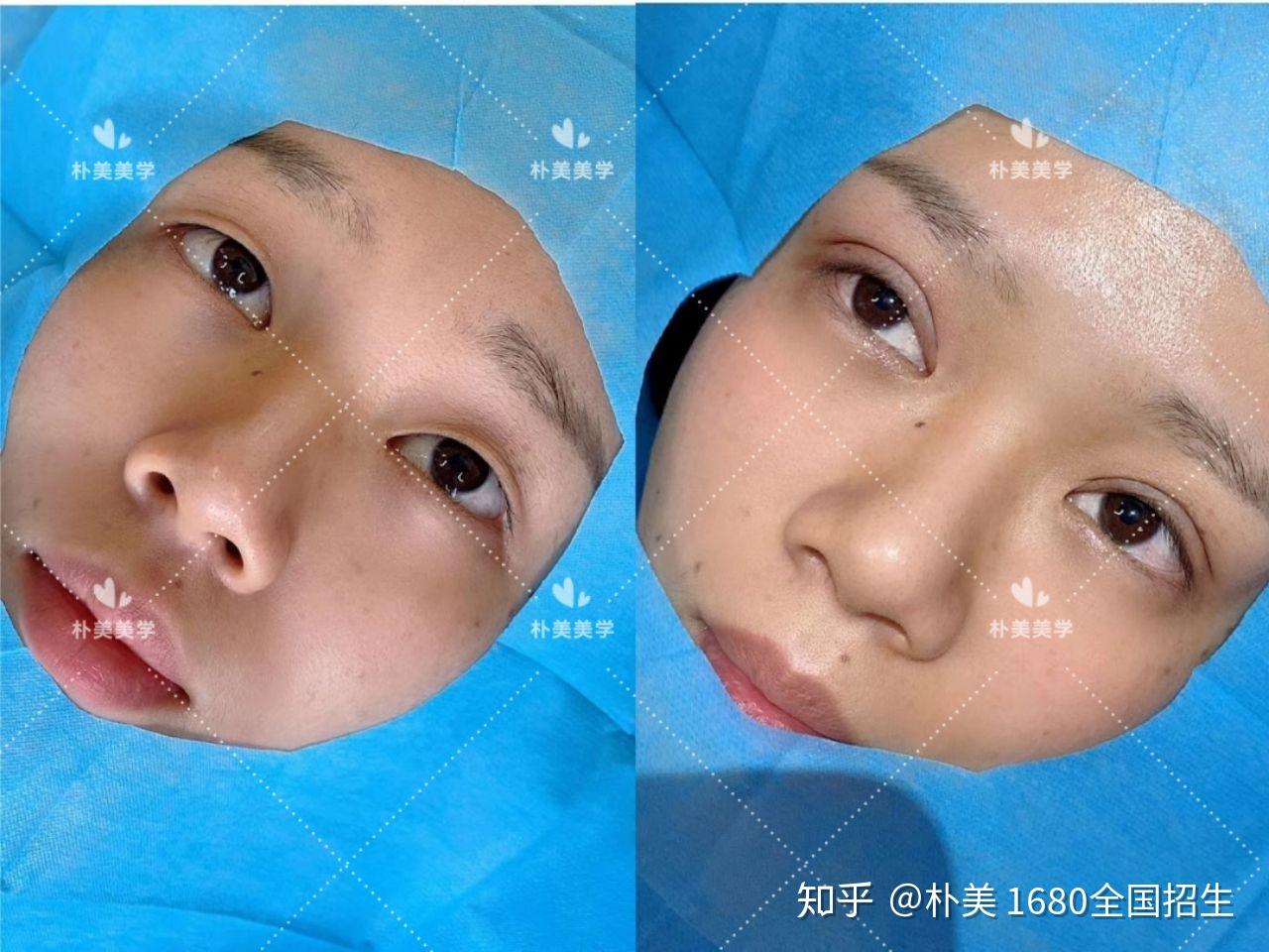 不开刀不手术免麻无痕迹双眼皮