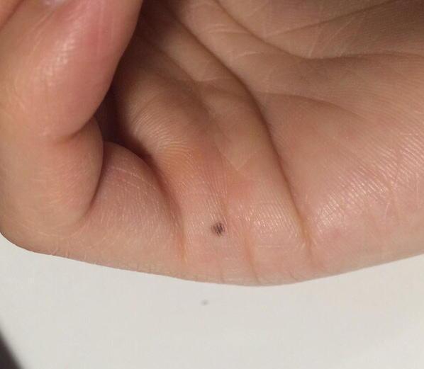 医生如果我这颗痣做手术切的话以后会不会长得更多啊