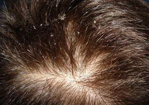 头皮脂溢性皮炎怎么办非常值得看的一篇文章