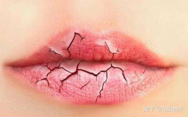 秋冬季嘴唇干燥 起皮 教你3招 拥有润润嘟嘟唇 知乎