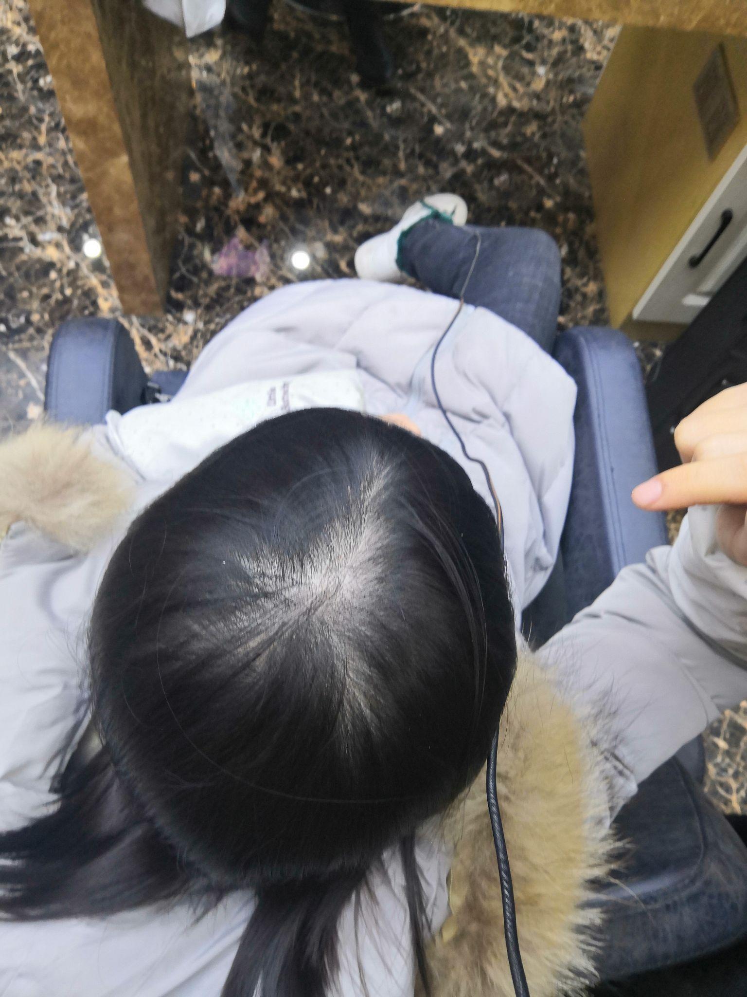 女生头顶头发少是什么体验 ?