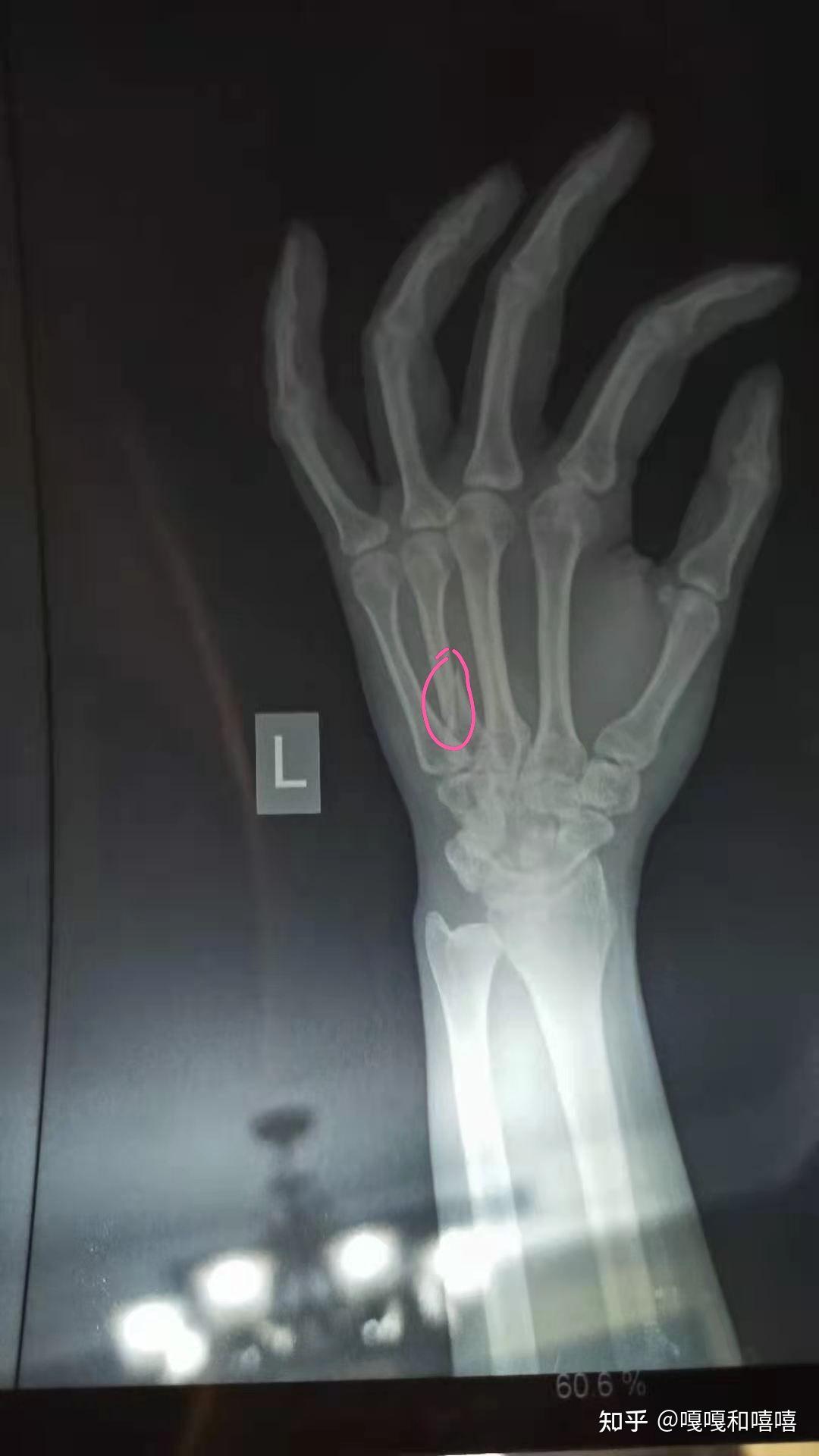 左手第四掌骨骨折图片图片