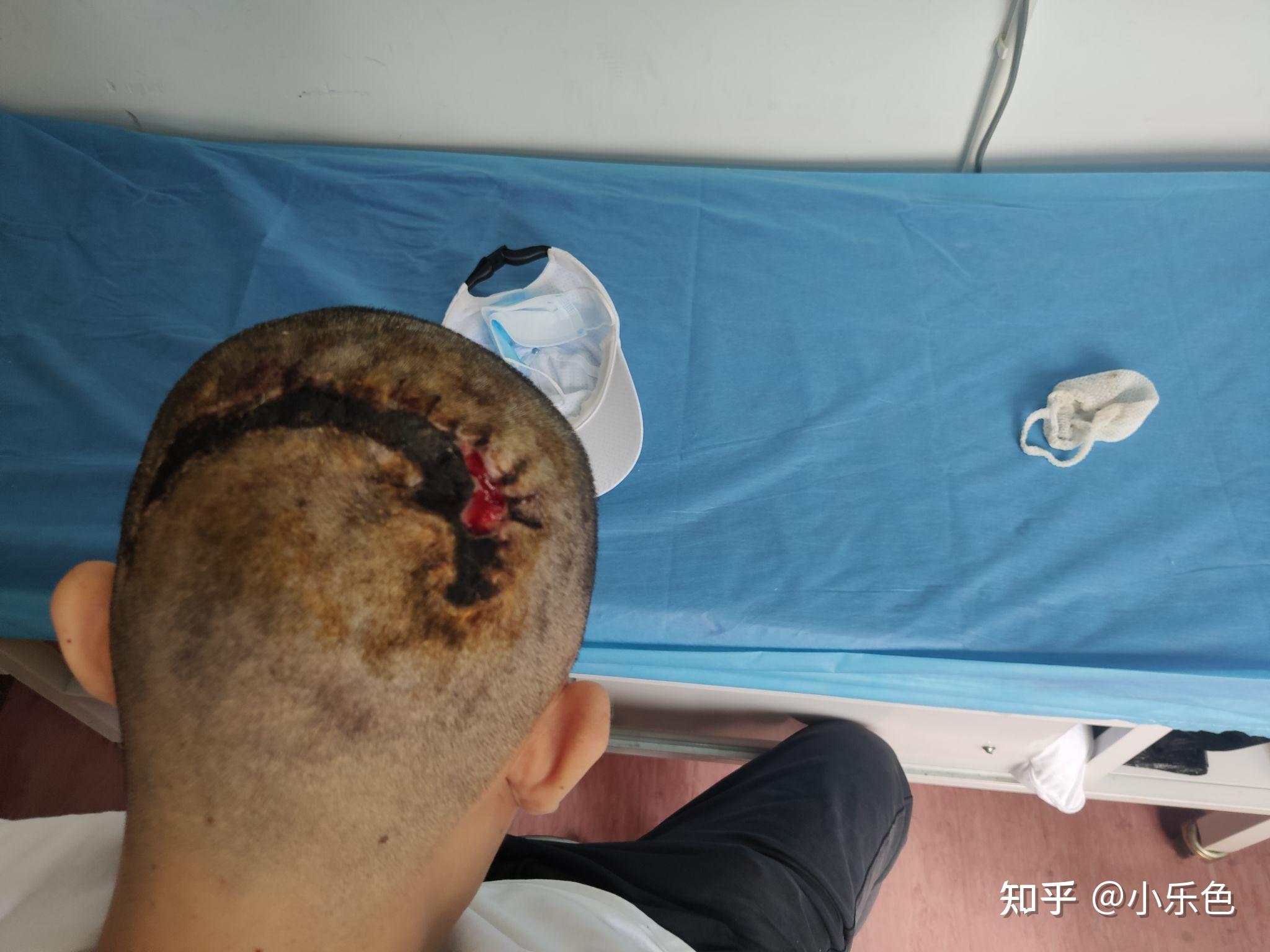 皮脂腺痣再见,经历过一次死亡.人活着就是找罪受