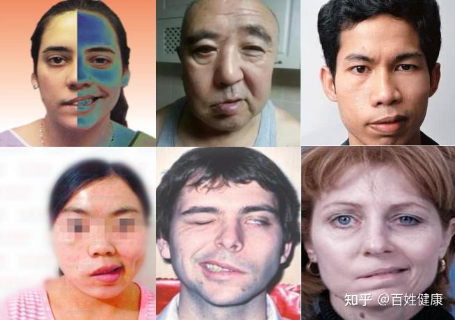 口歪眼斜不一定就是中风