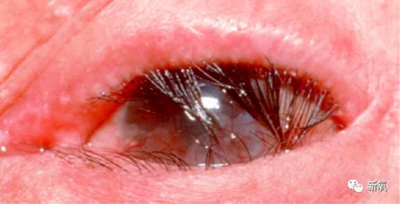 而双眼皮手术,因为需要睑板前的粘连操作,所以会有自然翘睫的效果.