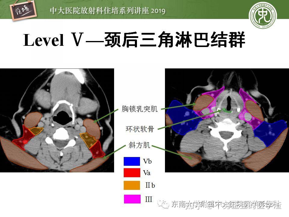 内乳淋巴结ct片图解图片