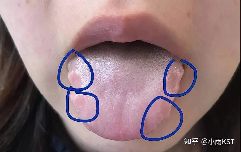 舌头两边有齿痕的原因有哪些? - 知乎