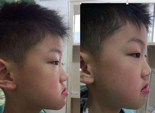 小孩儿骨性地包天要不要做矫正小孩儿骨性地包天矫正方法