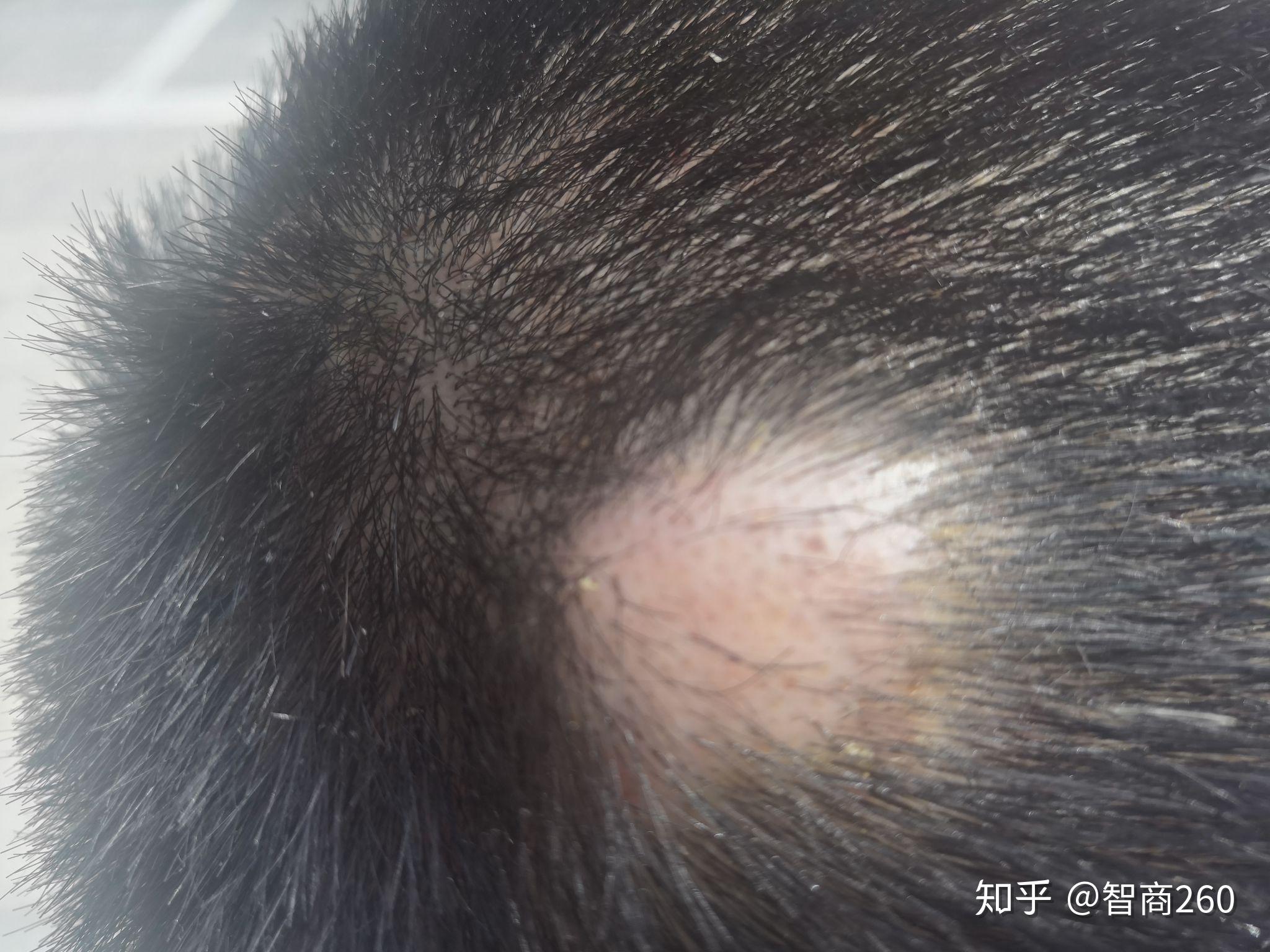 如何乐观的面对毛囊炎导致的头部多发囊肿