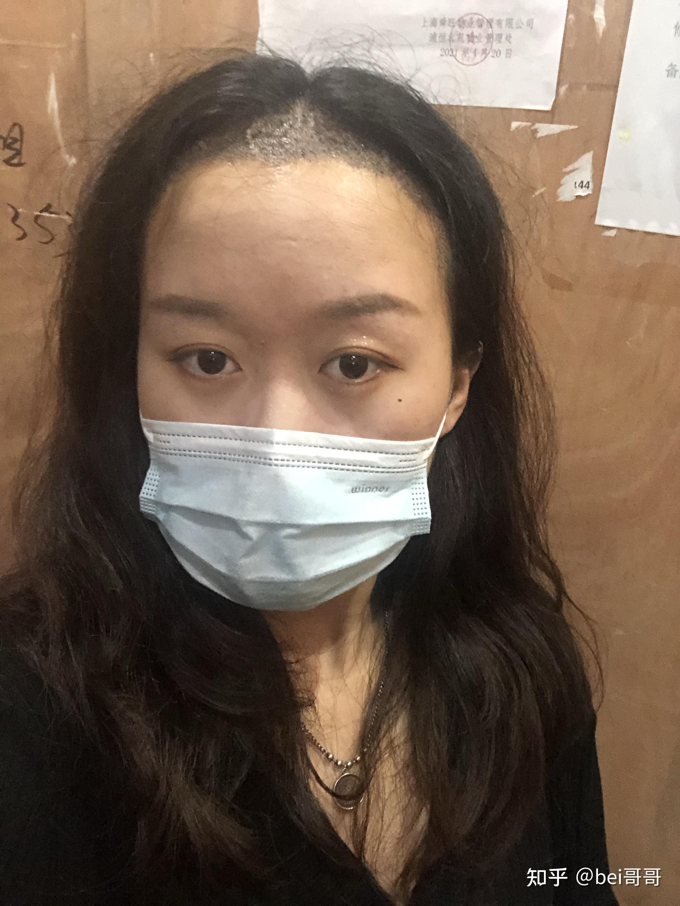 植发后皮屑多一块一块的(植发后皮屑多一块一块的怎么办)