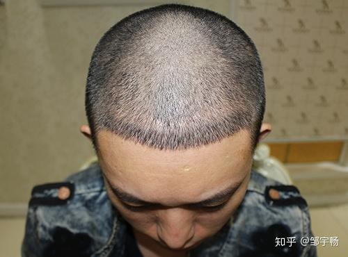 植发经历男性发际线后移m型脱发大额角脱发怎么办