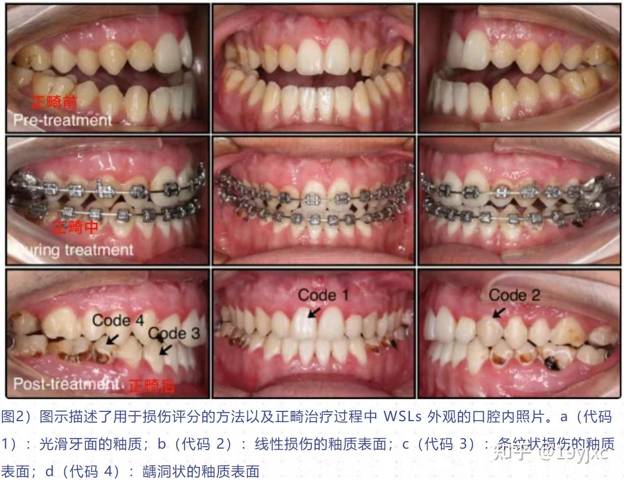 (转)正畸治疗中牙釉质脱矿的预防和治疗专家共识《International Journal of Oral Science》(2025,17: ...