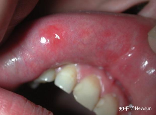 梅毒的初期症状? - 知乎