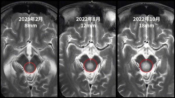 一台手术2个入路,一举歼灭脑干胶质瘤