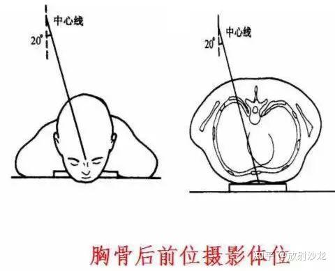 标准影像显示 显示胸骨正位全貌影像