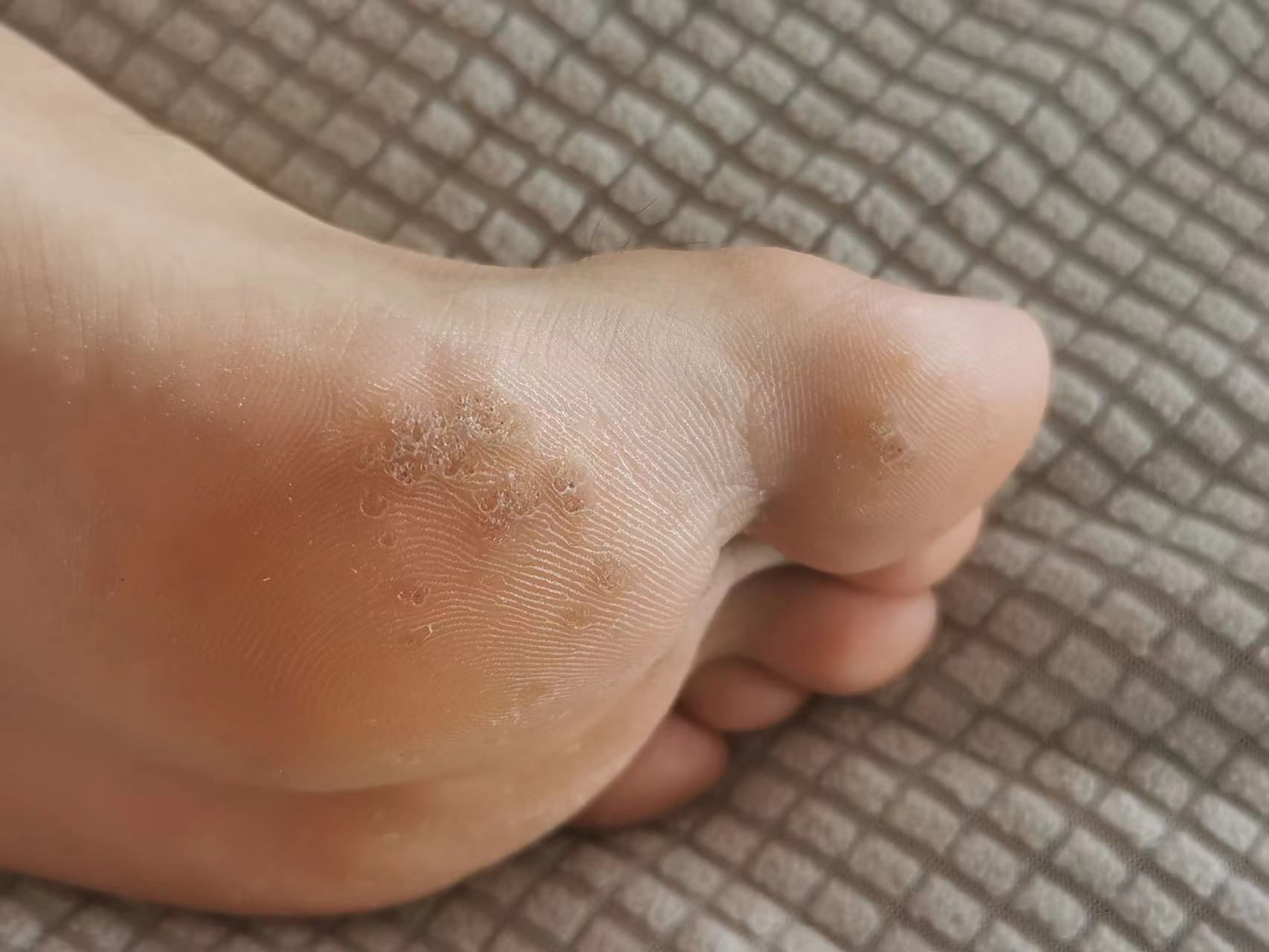 跖疣初期是什么样子? - 知乎