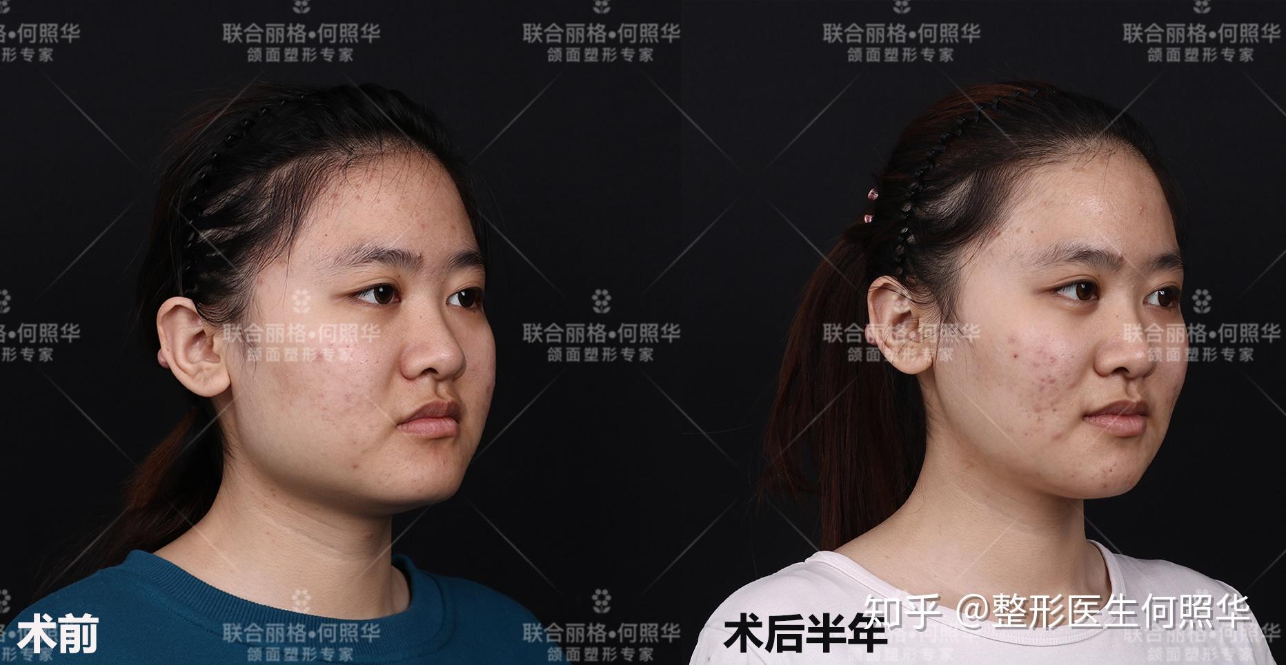 下颚角这样是不是基本方脸没救了？