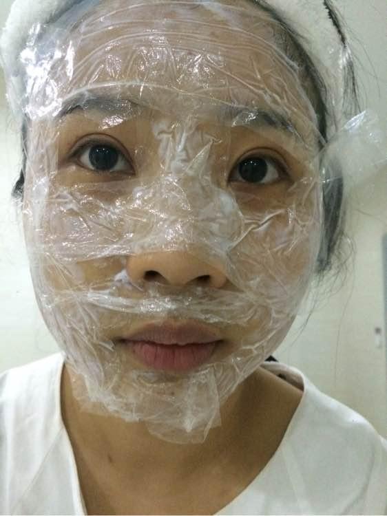 皮秒祛斑真人案例分享