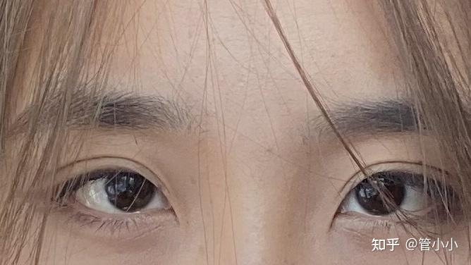 有没有内眦赘皮严重的人开眼角?急!