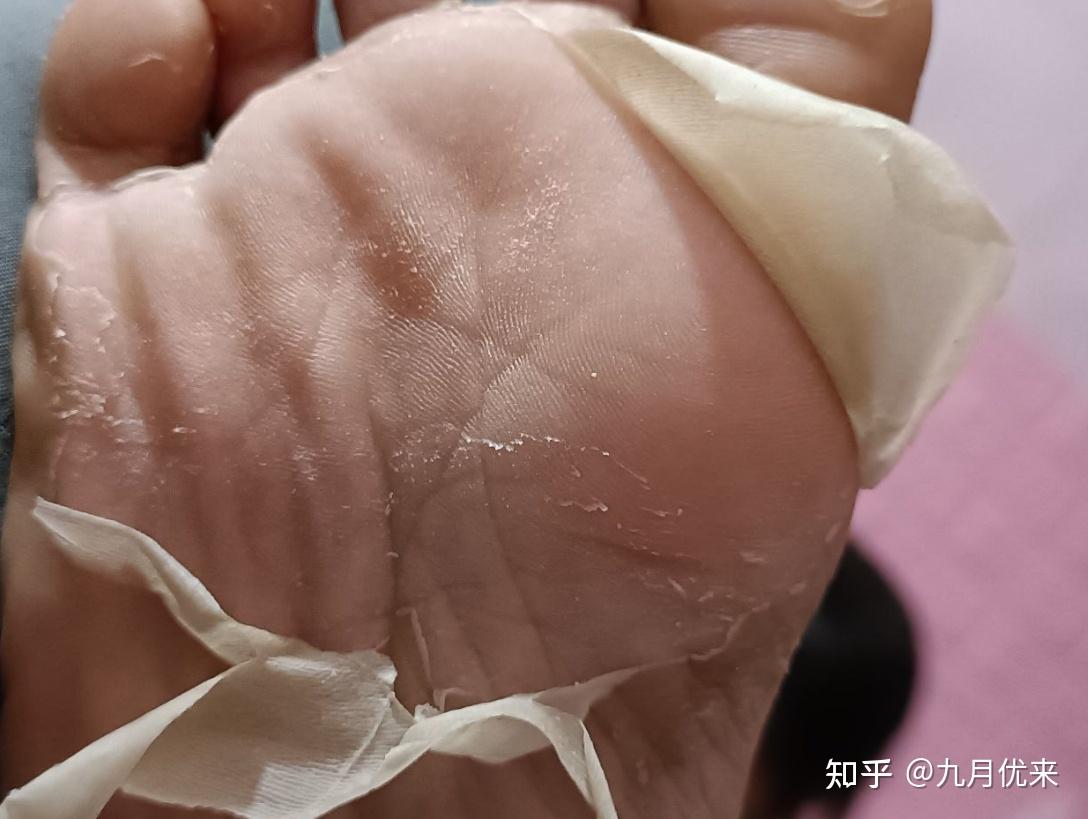 孕期得了灰指甲和脚气该怎么办? - 知乎