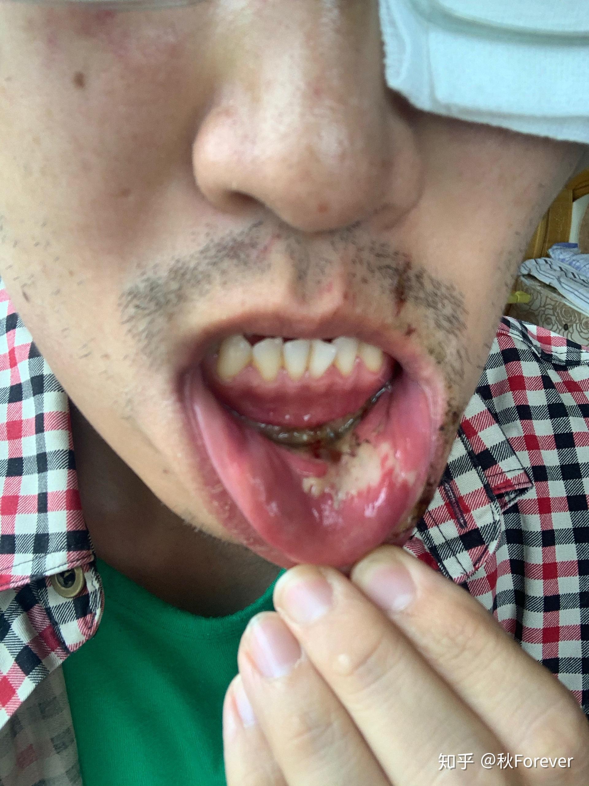 你见过最大的口腔溃疡有多大